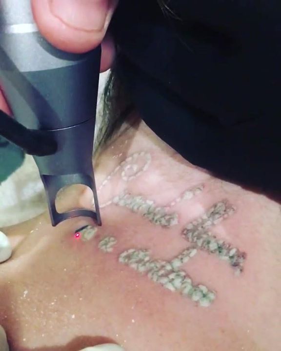 Tattoo Removal Treatments With Clinical Laser