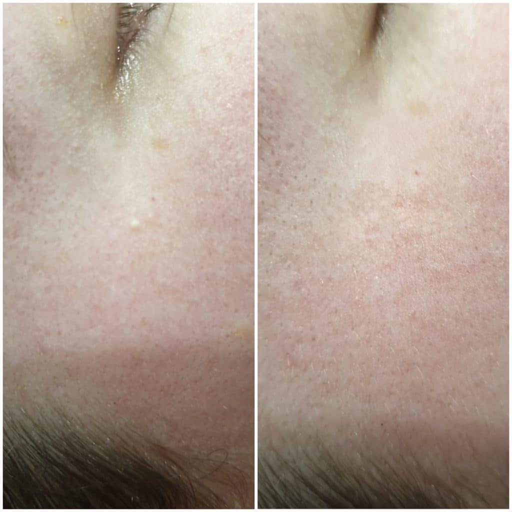 Milia Removal Done Using Our Clinical Skin Clear M…