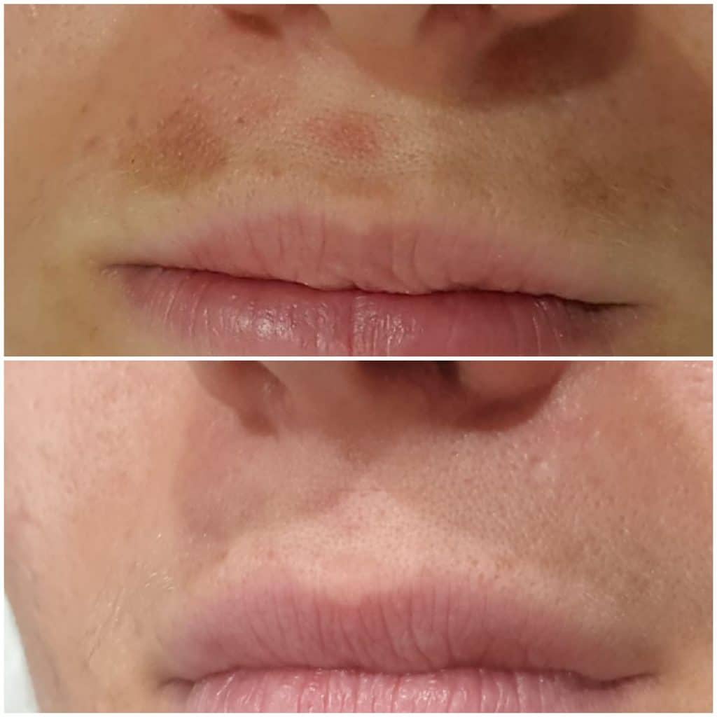 Before & After Pigmentation Removal

Results A…