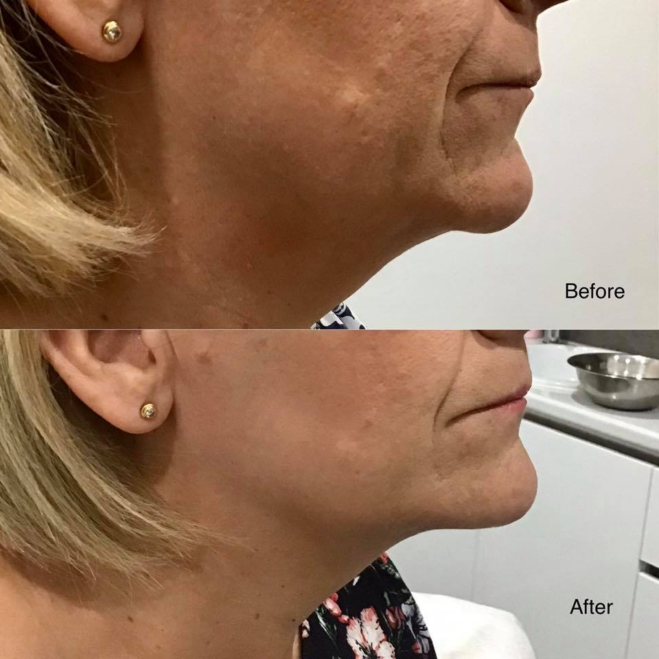 That Jawline 

Results Achieved Using Our New HIF…
