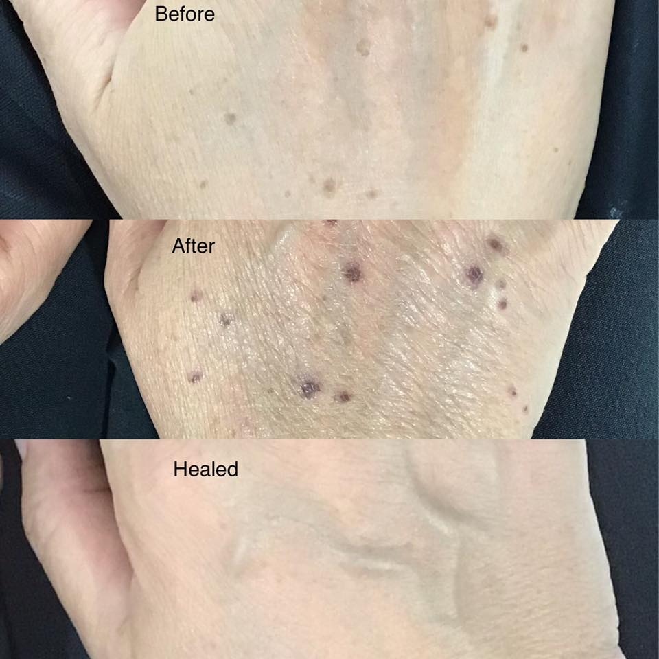 Age Spot Removal Using Our Q-Switch Laser Machine….