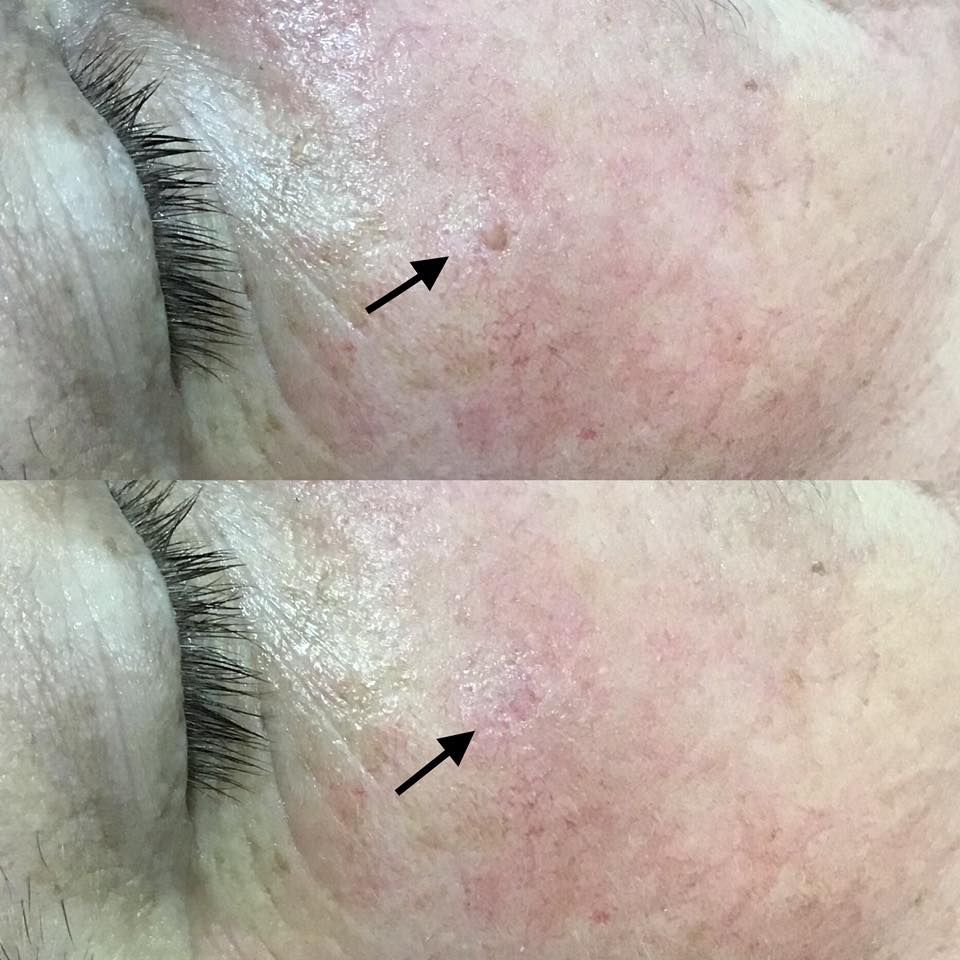 Before And After Lesion Removal By Nicole 

Please…