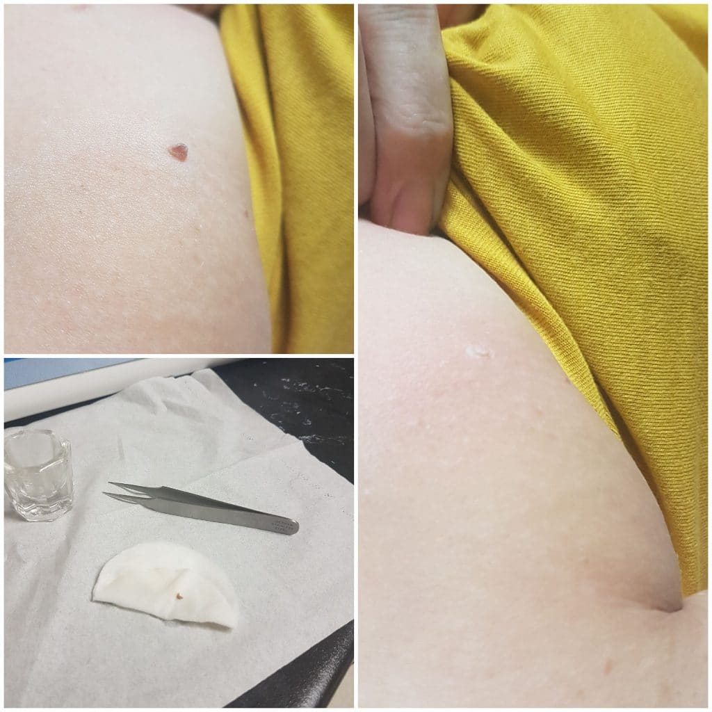 Skin Tag Removal By Nicole