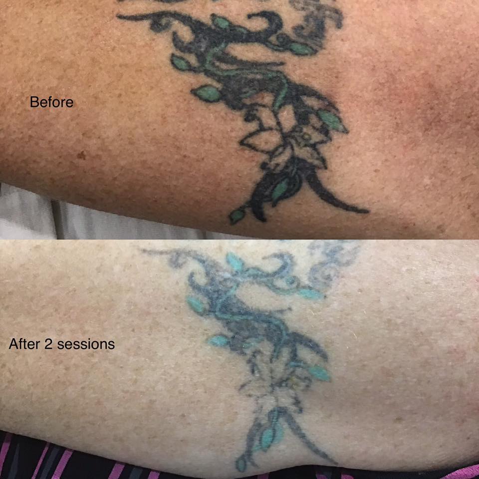 Tattoo Removal By Nicole
