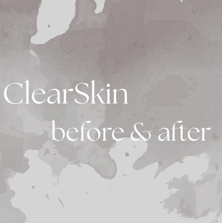 ClearSkin skin tag removal before and after at La Mode Gympie