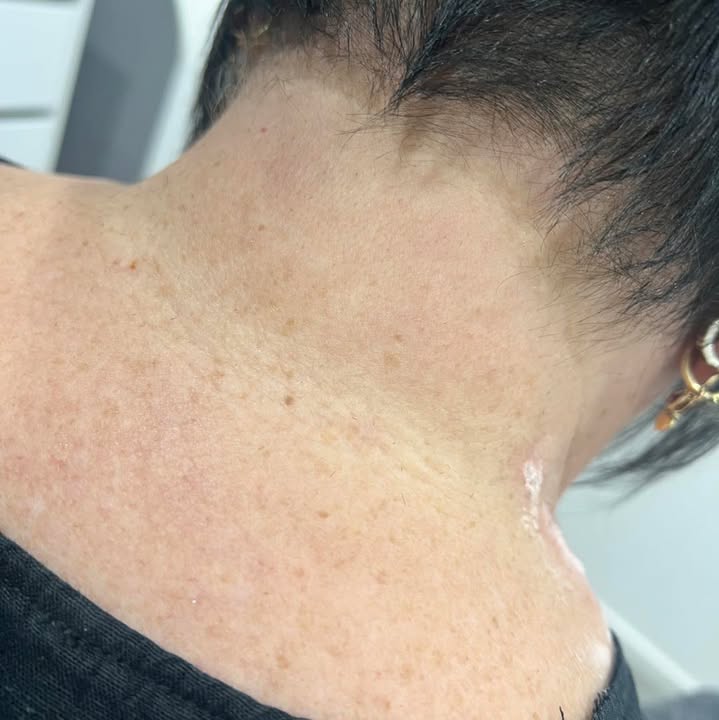ClearSkin skin tag removal before and after at La Mode Gympie
