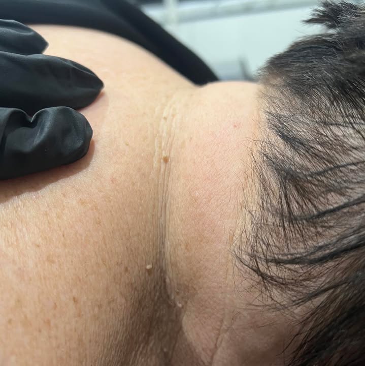 ClearSkin skin tag removal before and after at La Mode Gympie